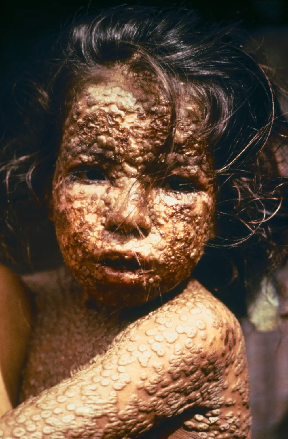 The Day Humanity Erased a Disease